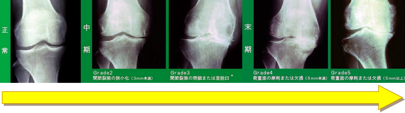 整形外科：人工関節置換術に関して｜診療のご案内｜医療法人財団 立川